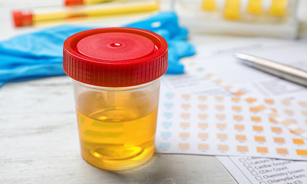 Исследование уровня магния в моче (суточная порция) Исследование уровня магния в моче (суточная порция)